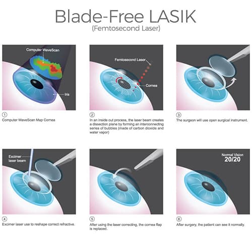 Blade Free LASIK Steps