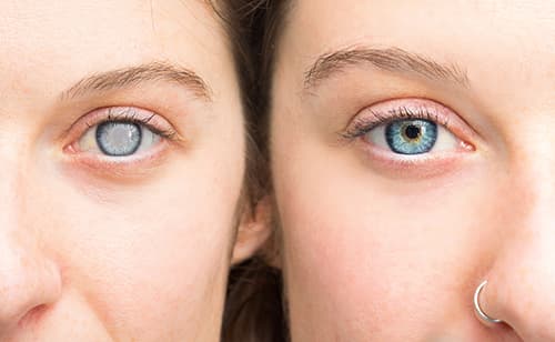 Woman before and after Cataract Surgery