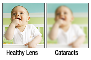 side by side comparison of vision with and without cataracts