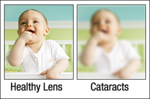 Healthy Lens vs Cataracts