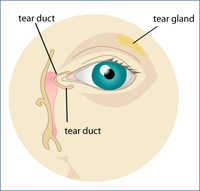 dry eye syndrome