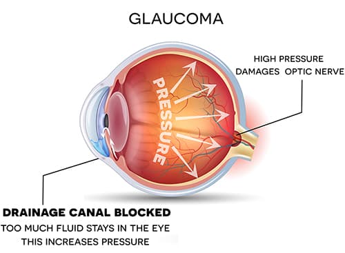 Medical illustration of Glaucoma