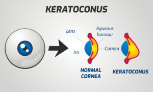 Keratoconus