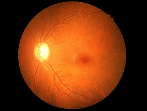Photo of a normal retina