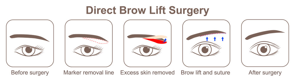 Direct Brow Lift Surgery Steps