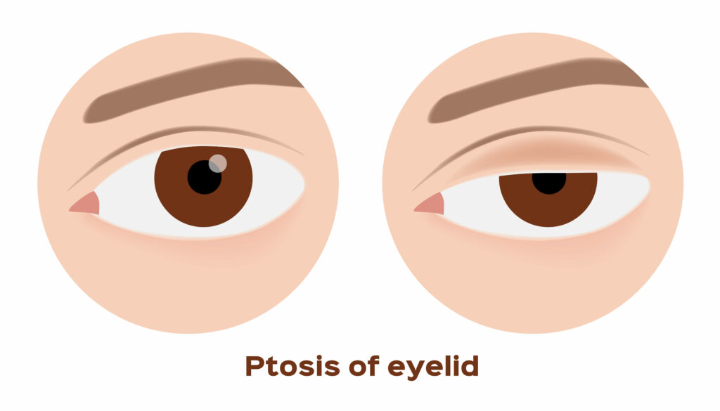 Ptosis of eyelid