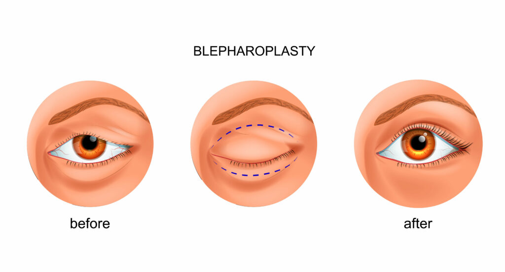 Blepharoplasty Before and After