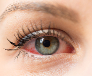 close up of dry eye