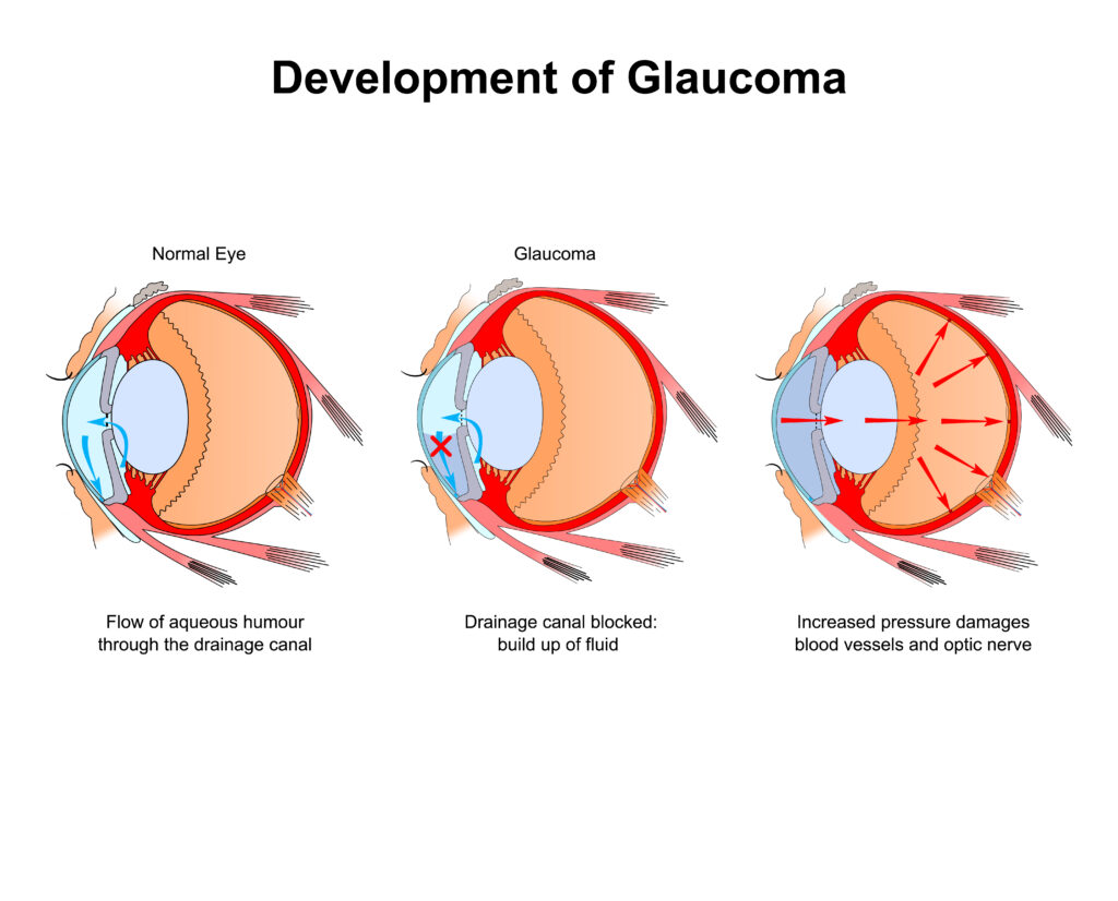 glaucoma