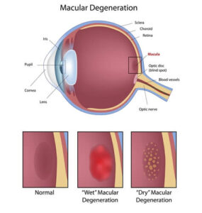 macular degeneration